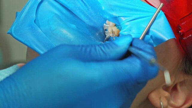 This detailed view of a complex dental procedure showcases the utmost precision and care given in patient treatment