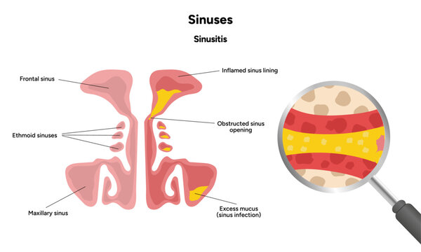 Sinuses anatomy healthy sinus and sinusitis. Nose nasal anatomy. Inflammation Nasal Cavity