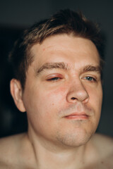 Obraz premium Selective focus on swollen and painful red upper eye lid with onset of stye infection due to clogged oil gland and staphylococcal bacteria. Close up right upper eyelid abscess.