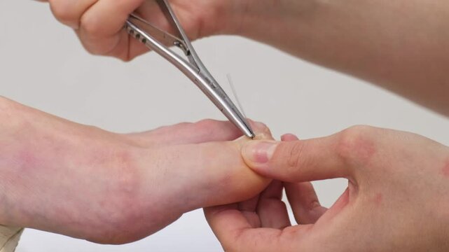 The podiatrist twists the wire around the patient's nail using pedicure forceps in the salon during the procedure. Toenail Treatment