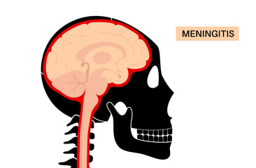Meningitis medical poster