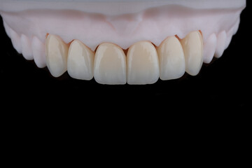 High-quality six dental crowns made of zirconium for fixation to the frontal teeth of upper jaw.