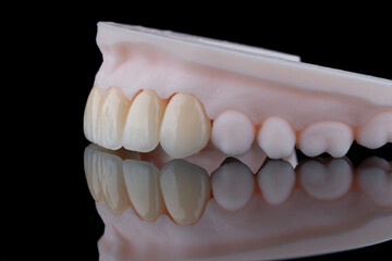 Side view of six dental crowns made of zirconium for fixation to the frontal teeth of upper jaw.