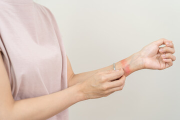 Dermatology asian young woman, girl allergy, allergic reaction dermatitis from wrist bracelet,...