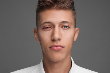 Conjunctivitis. Young man with red eye on grey background