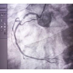 Coronary angiogram of right coronary artery during cardiac catheterization with dye. Findings...