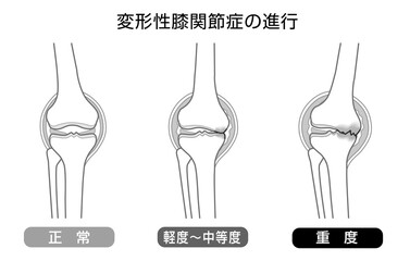 変形性膝関節症の進行を表したモノトーンのイラスト