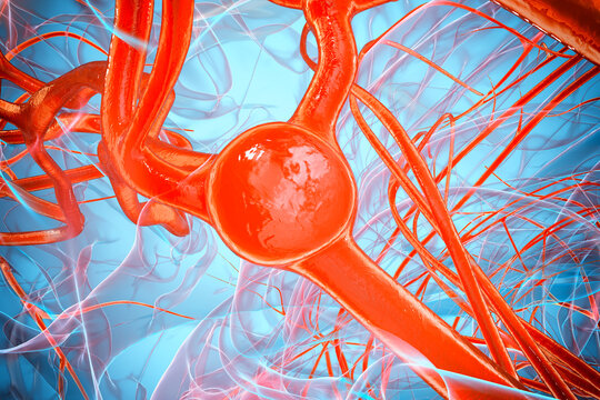 A close-up view of a saccular aneurysm on a brain artery, 3D illustration