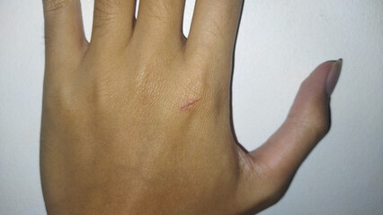 Close-Up of a Hand with a Small Skin Scratch on Its Surface