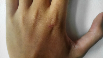 Fototapeta premium Close-Up of a Hand with a Small Skin Scratch on Its Surface