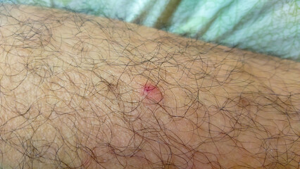 An intimate macro photograph displaying a red bump skin irritation on a hairy surface, suggesting a...