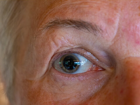 CLOSE UP, PORTRAIT: Greatly enlarged pupil of the left eye of an elderly woman after visiting ophthalmologist. Consequences of powerful drug that allows medical examination of the back of the eye.