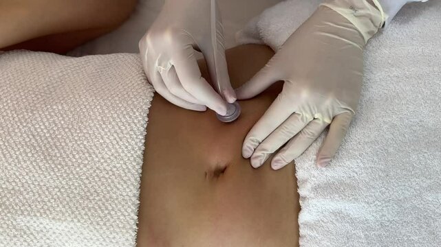 Carboxterapia procedimento est&eacute;tico para barriga