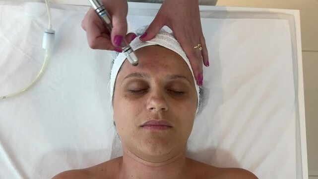 Peeling de Diamante procedimento est&eacute;tico facial 