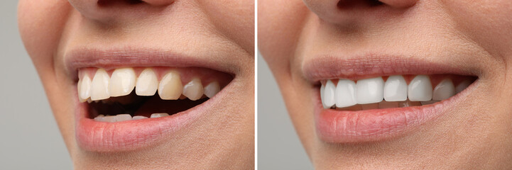 Obraz premium Woman smiling before and after procedure dental veneers placement on grey background, closeup. Aesthetic improvement of teeth, collage