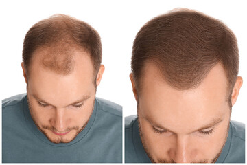 Obraz premium Man with hair loss problem before and after treatment on white background. Collage of photos