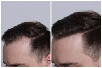 Man with hair loss problem before and after treatment on light grey background, closeup. Collage of...