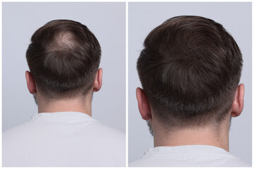 Man with hair loss problem before and after treatment on light grey background, back view. Collage of photos