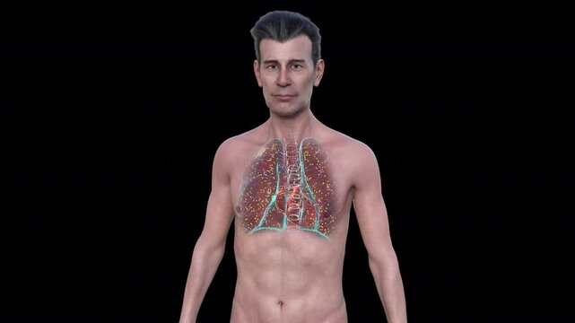 Lung miliary tuberculosis in a middle-aged Caucasian man, 3D animation showing numerous small nodules throughout lung tissue.