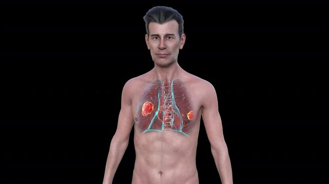 Lung mucormycosis, 3D animation showing fungal infection caused by Mucorales fungi, highlighting multiple irregular lung nodules.