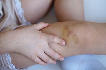 Bruise on childs knee , close-up injury photo