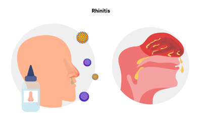 Nose Nasal diseases. Rhinitis symptoms. Allergy, rhinitis or cold medical diagram