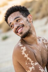 A confident young man with vitiligo and short hair. His unique skin patterns are highlighted by soft natural light. He radiates self-love and strength, embracing her natural beauty.