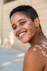 A confident young woman with vitiligo and short hair. Her unique skin patterns are highlighted by soft natural light. She radiates self-love and strength, embracing her natural beauty