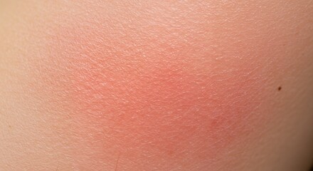 Fototapeta premium Close-up Detailed View of Sunburnt Skin Showing Redness and Textured Surface
