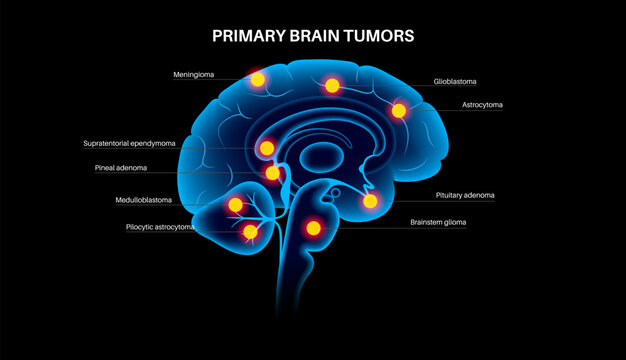 Primary brain tumors