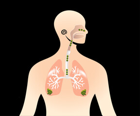 Aflatoxins,  human health, carcinogen