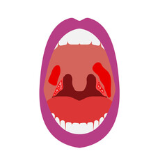 tonsil