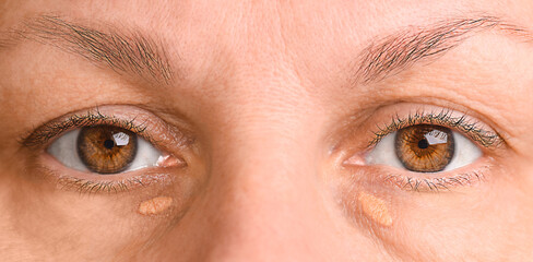 Brown eyes of an adult woman with pathology of cholesterol plaques and drooping eyelid