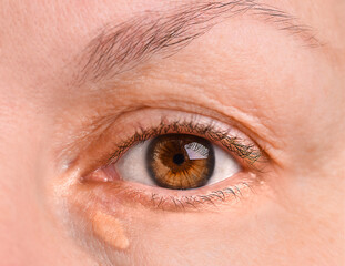 Woman's right eye close-up with xanthelasma, fatty plaque under the eye