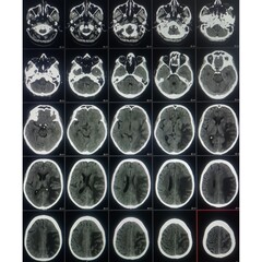 CT, MRI scan of brain, Intraventricular hemangioma with adjoining periventricular seepages and herniation.