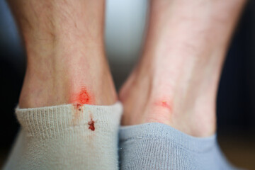 rubbed male heels. bloody calluses from uncomfortable shoes. the correct selection of shoes, a...