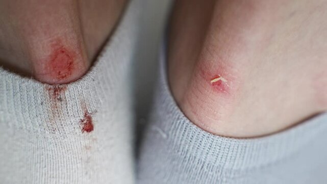 rubbed male heels. bloody calluses from uncomfortable shoes. the correct selection of shoes, a remedy for calluses, ways to stretch shoes.