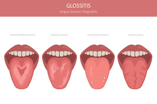 Glossitis tongue disease. Oral medicine. Medical infographic design. Vector illustration