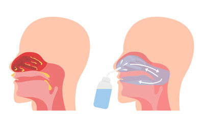 Irrigation of nasal passages. Relief and treatment from allergies, reducing inflammation, cleaning the nasal passages, hydration, improvement of nasal function