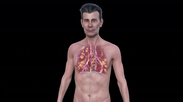 A man with lungs affected by cystic fibrosis, a genetic disorder causing thick mucus production. 3D animation shows bronchi dilation due to mucus accumulation and inflammation.