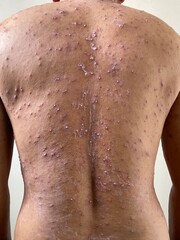 Fototapeta premium Adult back body with virus skin disease pustules red rash smallpox monkeypox pox 