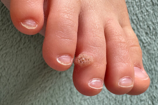 Close-up of a child's foot showing a wart on toe. The skin texture and growth are clearly visible, highlighting a common dermatological condition