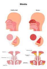 Nose Nasal diseases. Rhinitis symptoms. Allergy, rhinitis, cold medical diagram