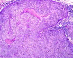 Skin. Basal cell carcinoma