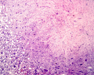 Kidney fibroma