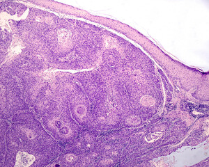 Human skin. Squamous cell carcinoma