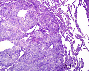 Human lung. Squamous cell carcinoma metastasis