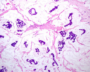 Human breast. Mucinous carcinoma