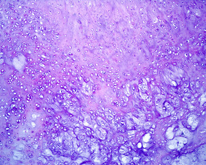 Cartilage. Chondroma