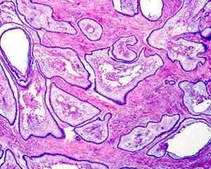 Human maxillary. Ameloblastoma